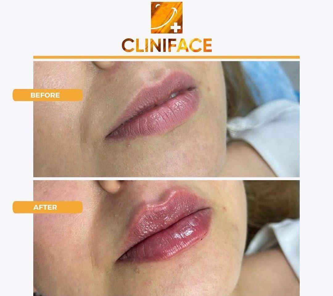 Процесс увеличения губ