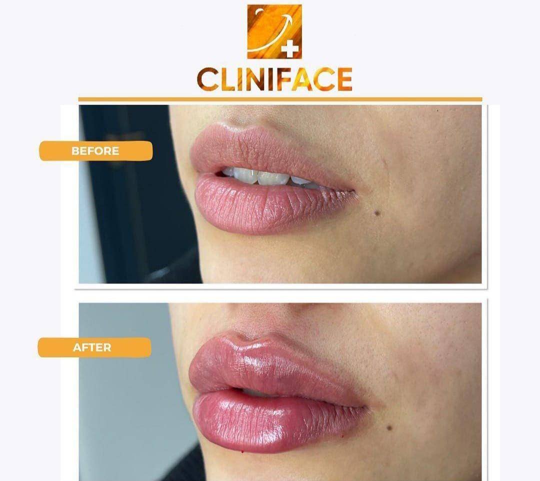 Процесс увеличения губ