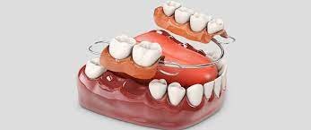 Dental Prosthesis Products