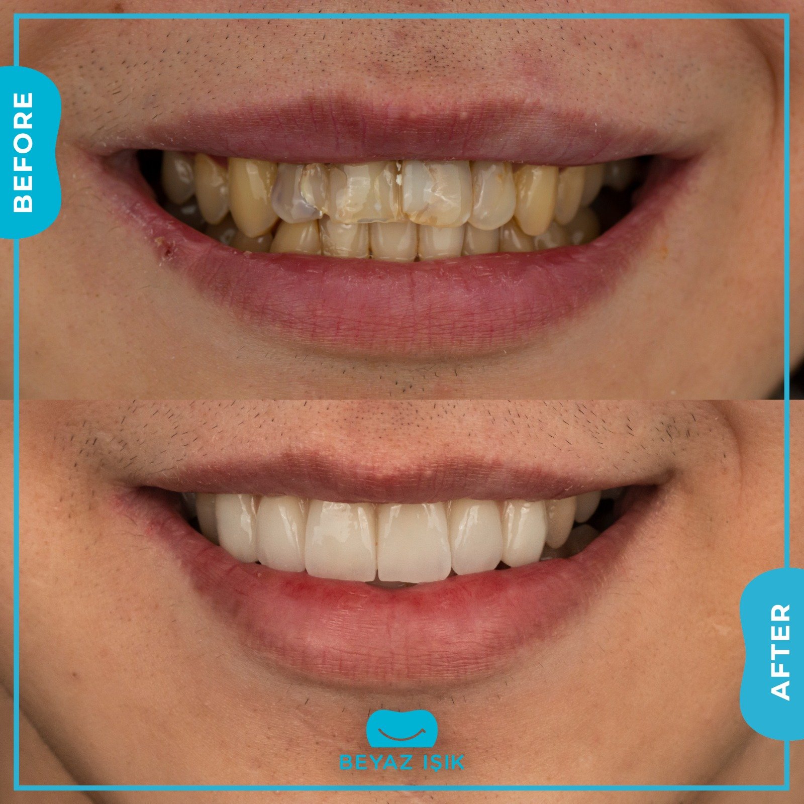 Циркониевое покрытие