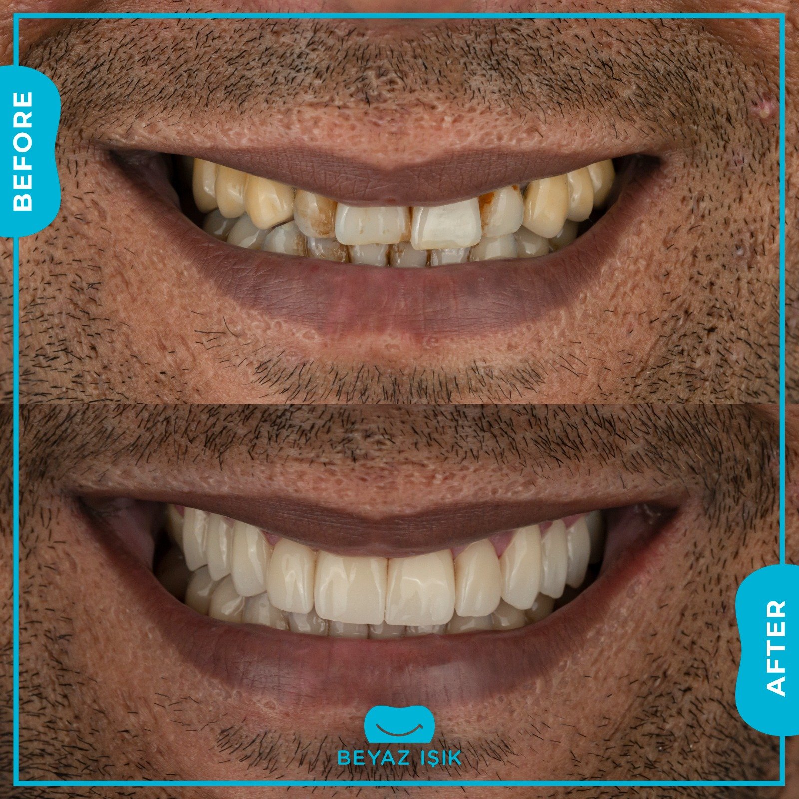 Циркониевое покрытие