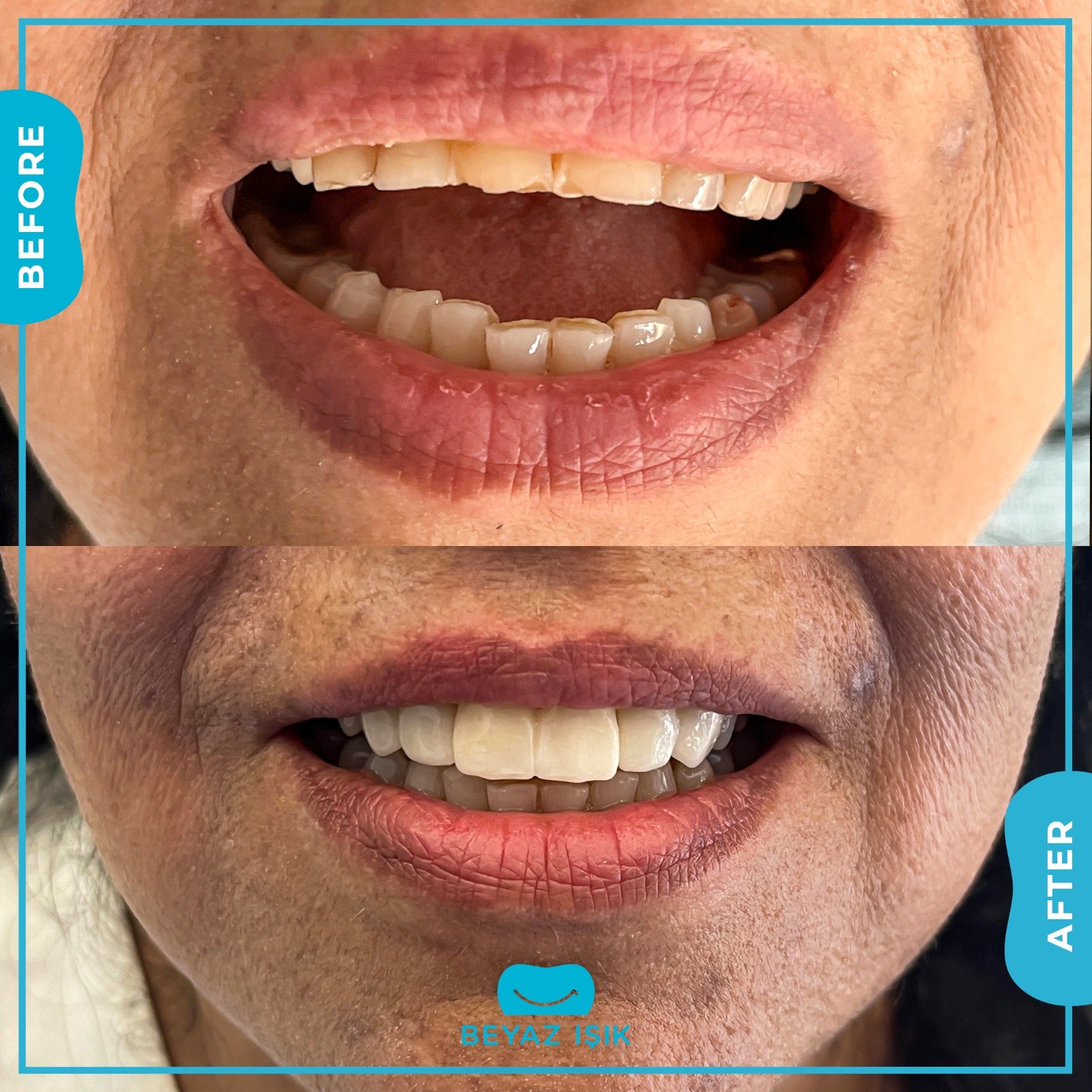 Циркониевое покрытие