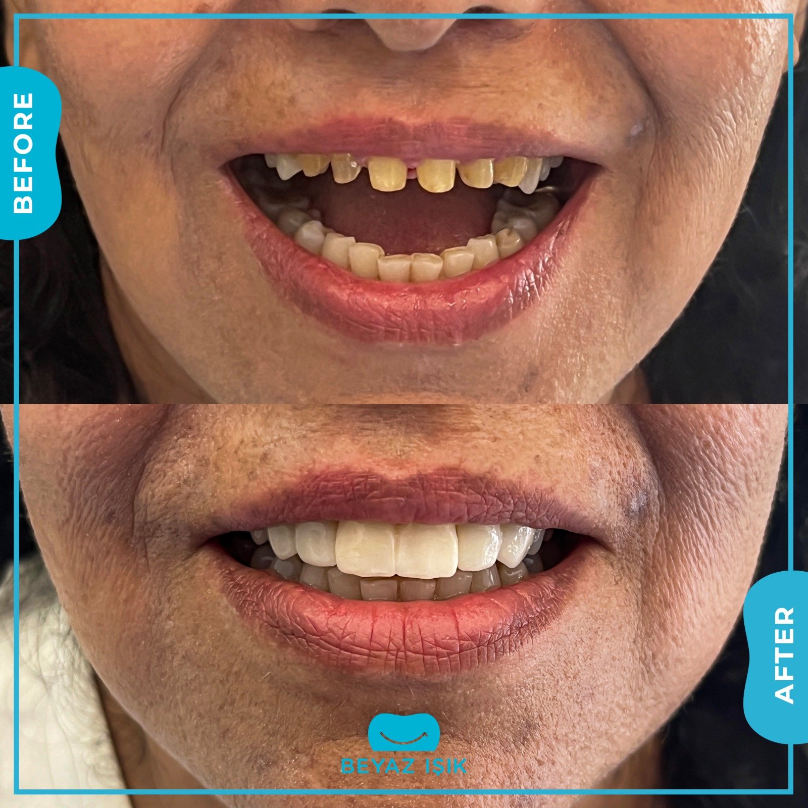 Циркониевое покрытие