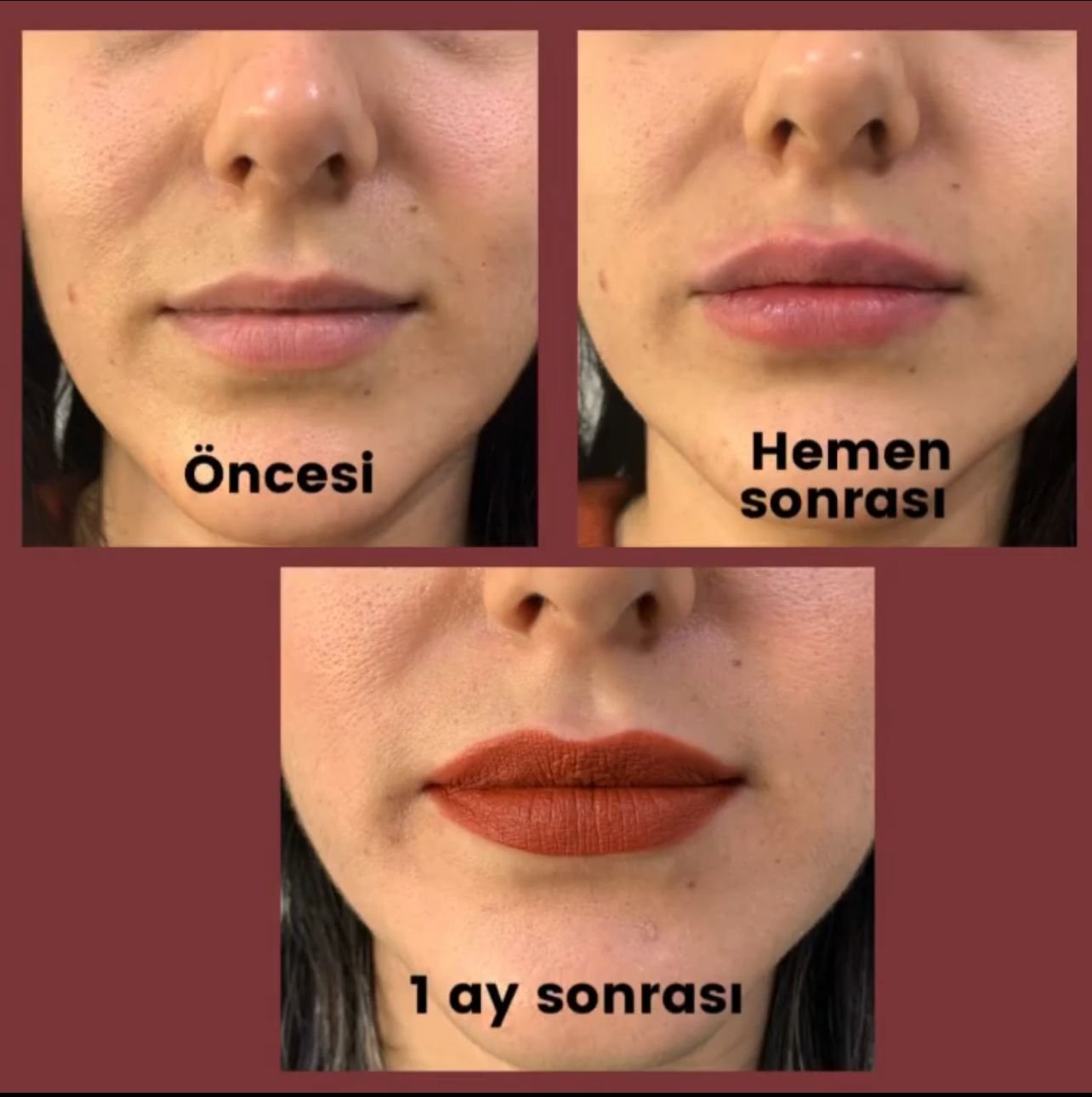 Филлер для губ