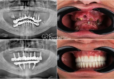 dental-wise-implant3