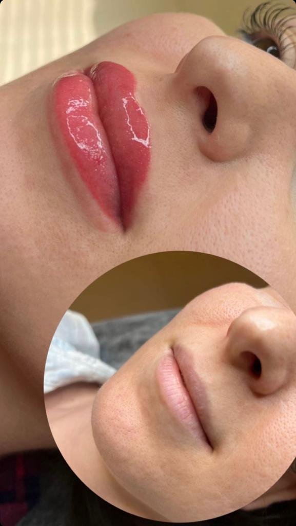 Lip augmentation and permanent coloring