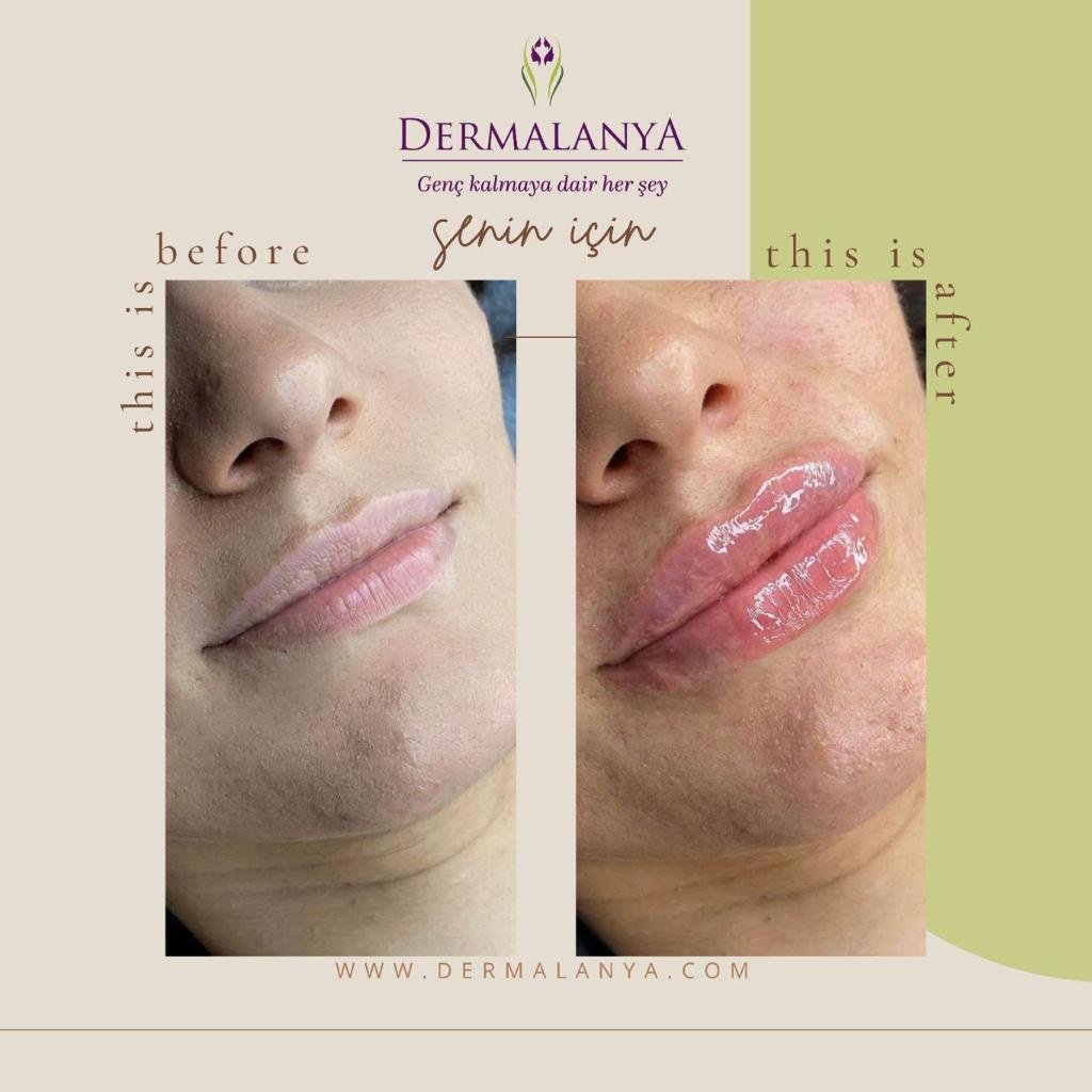 Lip augmentation and permanent coloring