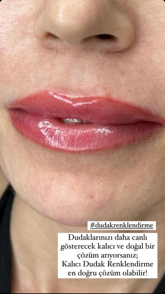 Lip augmentation and permanent coloring
