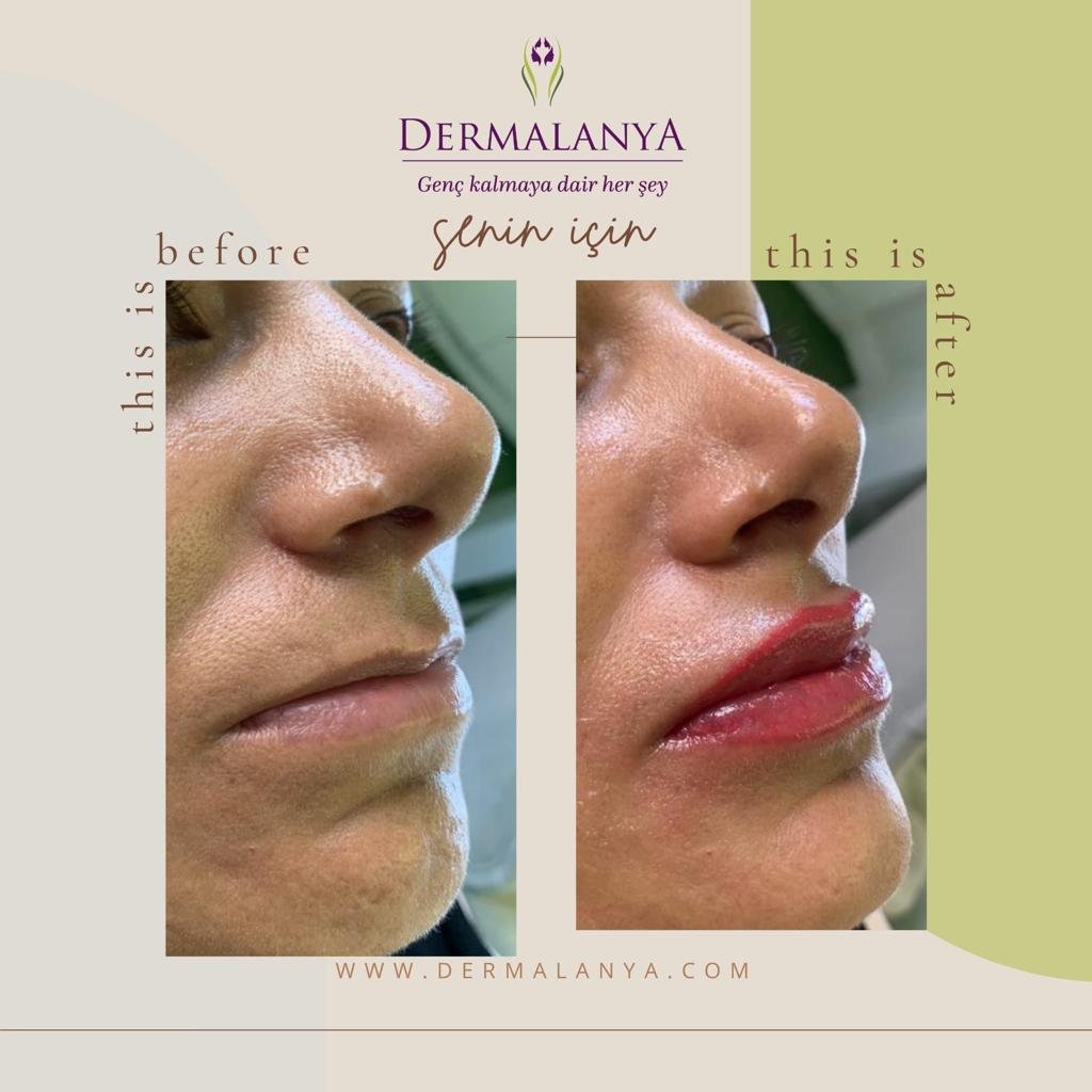 Lip augmentation and permanent coloring