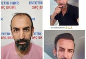 Saç Ekimi ( Fue Yöntemi )