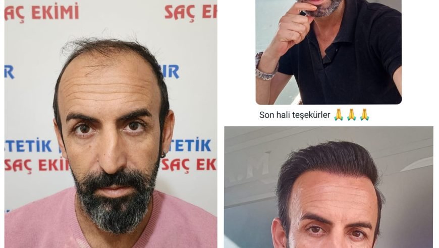 Saç Ekimi ( Fue Yöntemi )