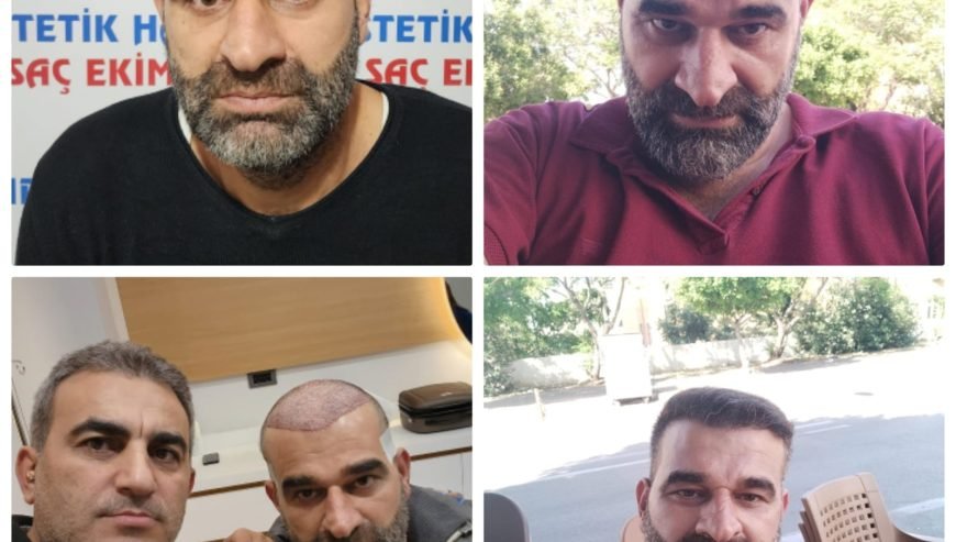 Saç Ekimi ( Fue Yöntemi )