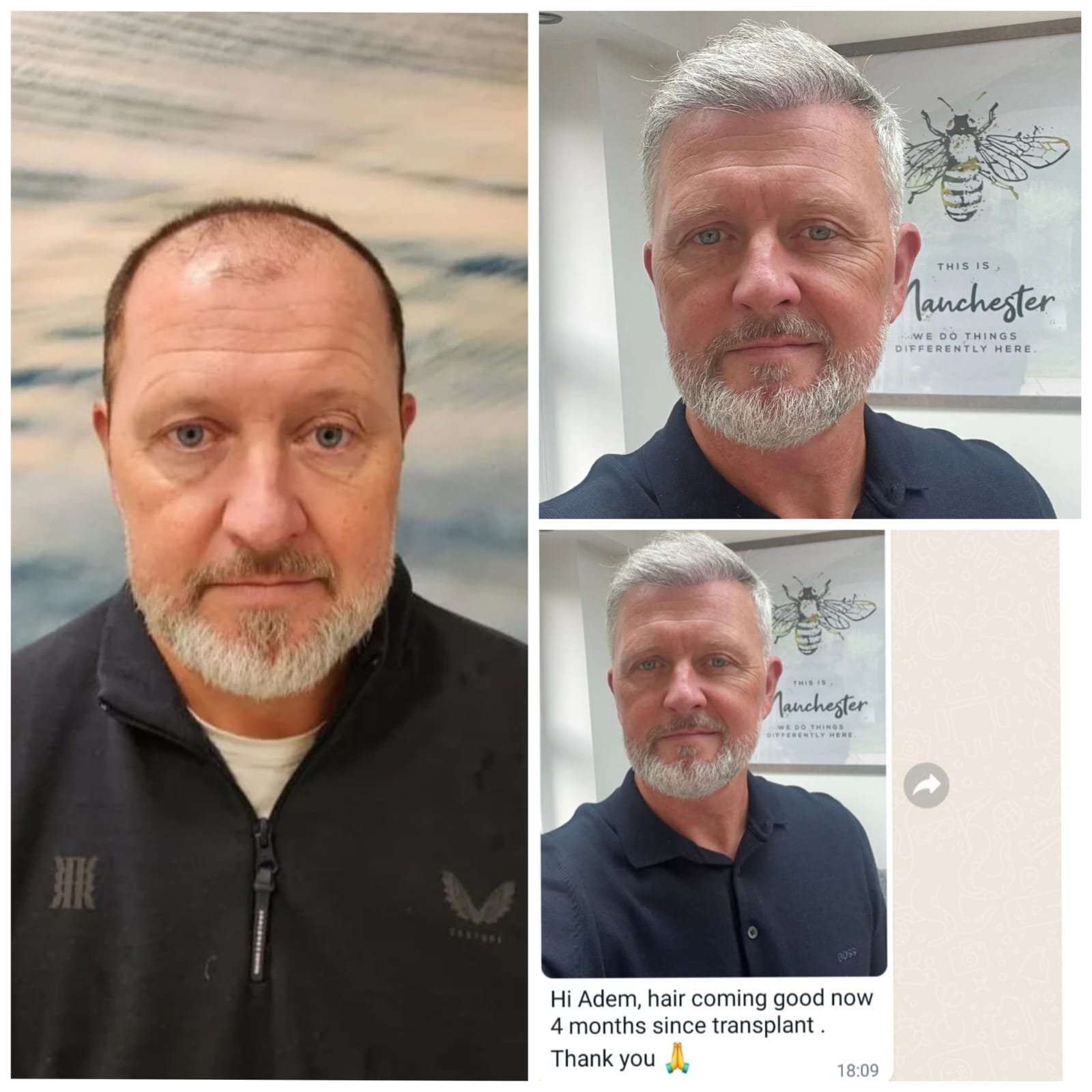 Hair Transplantation (Fue Method)