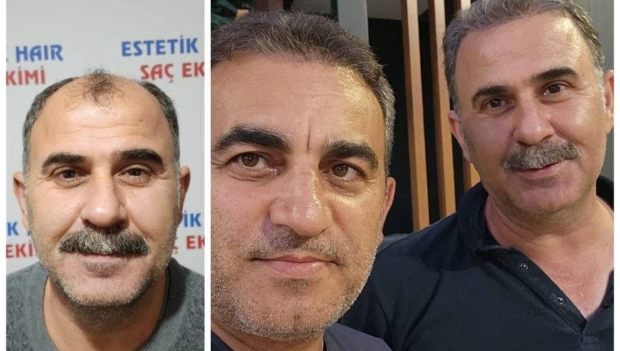 Saç Ekimi ( Fue Yöntemi )