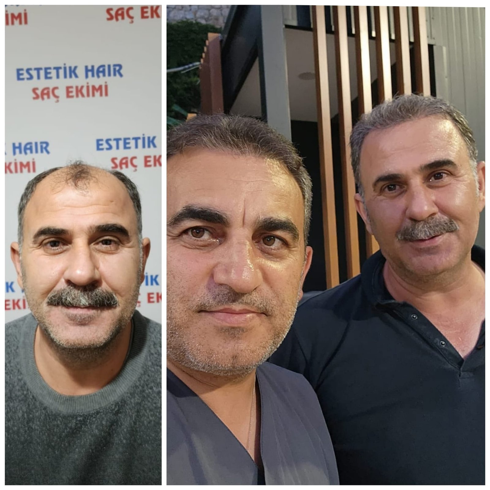 Hair Transplantation (Fue Method)