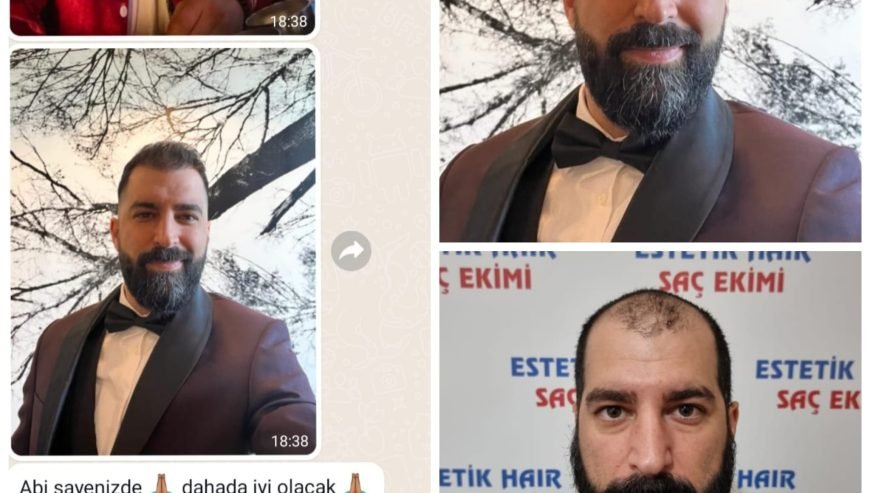 Saç Ekimi ( Fue Yöntemi )