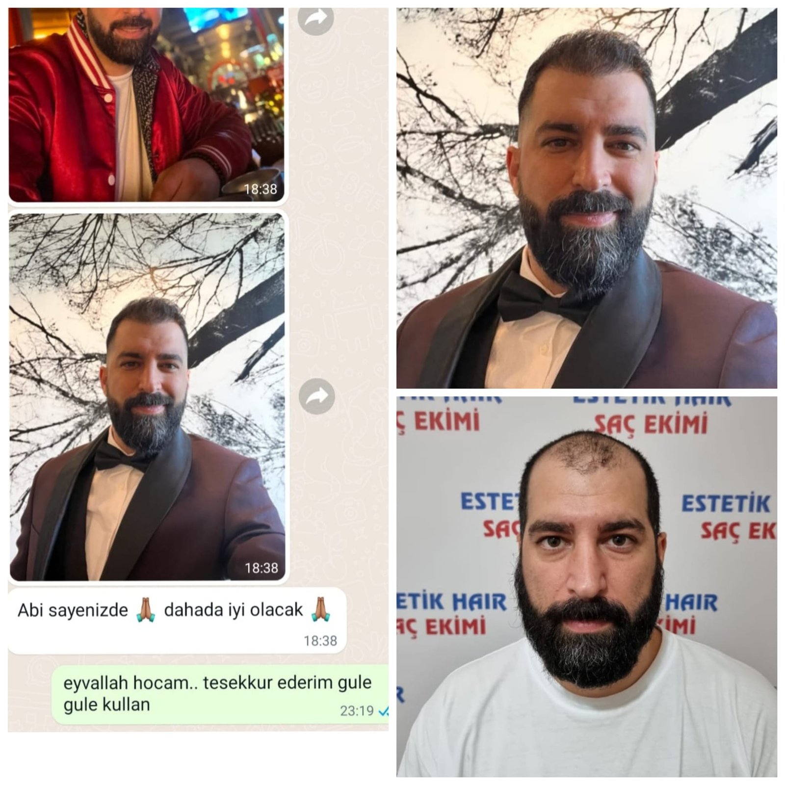 Hair Transplantation (Fue Method)