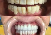 Porcelain tooth veneer