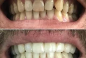 Porcelain tooth veneer