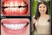 Smile Design