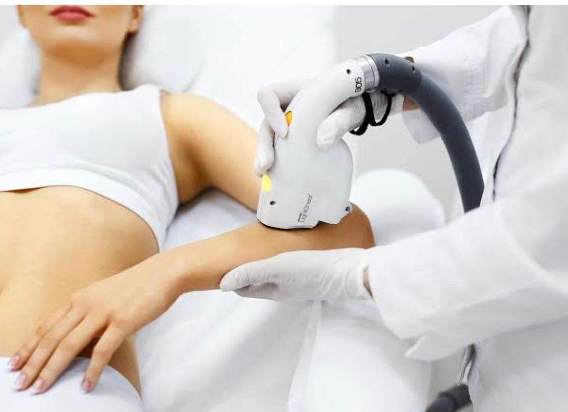 лазерное удаление волос